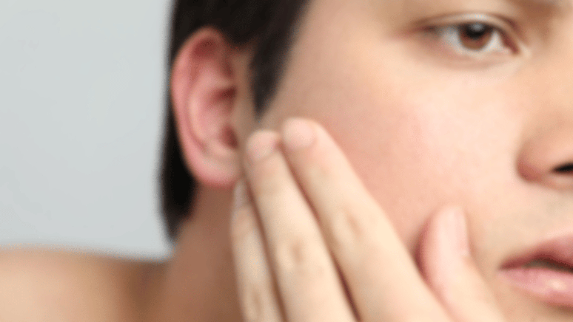 Huidadvies Acne