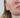 Huidadvies Rosacea