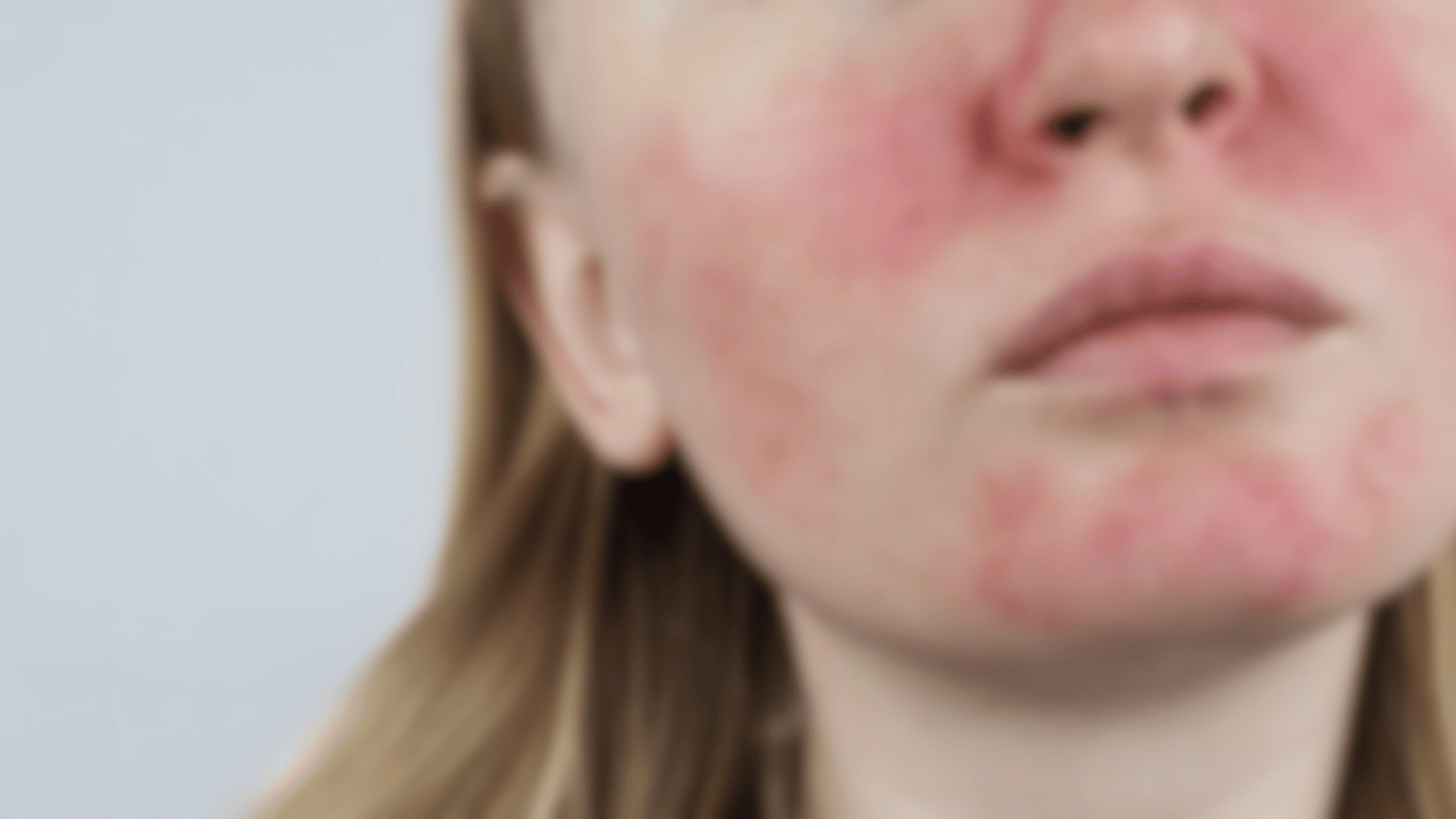 Huidadvies Rosacea